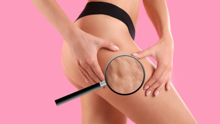 Schröpfmassage bei Cellulite - Physiotherapie Hertfelder