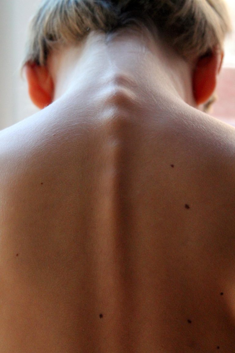 Physiotherapie bei Multipler Sklerose hilft, Beweglichkeit zu erhalten und Muskelversteifungen vorzubeugen. Erfahre, welche Übungen unterstützen.